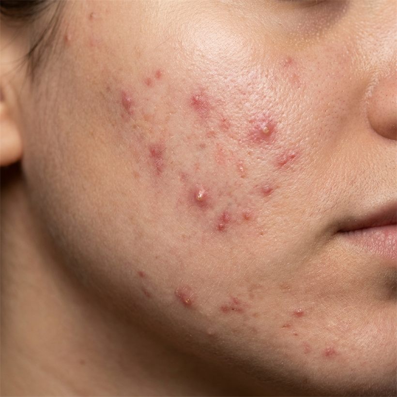 Close-up of skin with active acne on the cheek