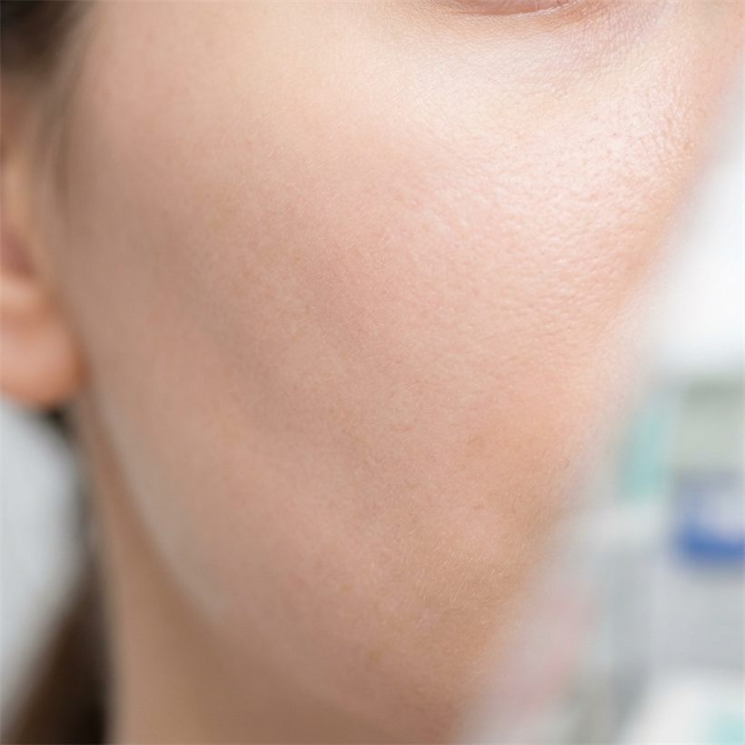 Skin showing improved even tone after treatment