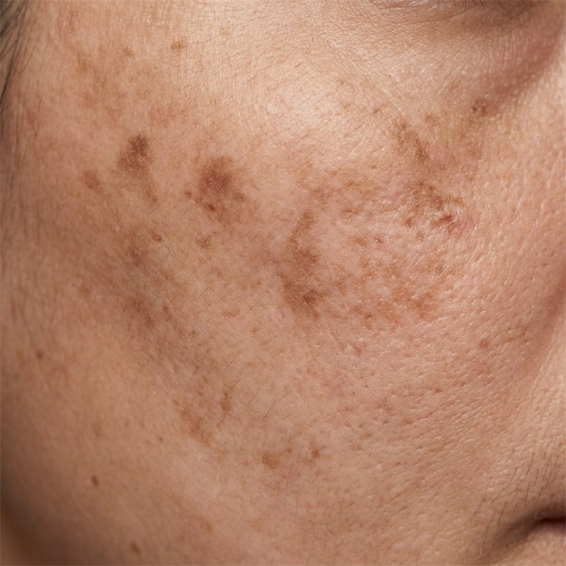 Symmetrical brown pigmentation across the cheeks