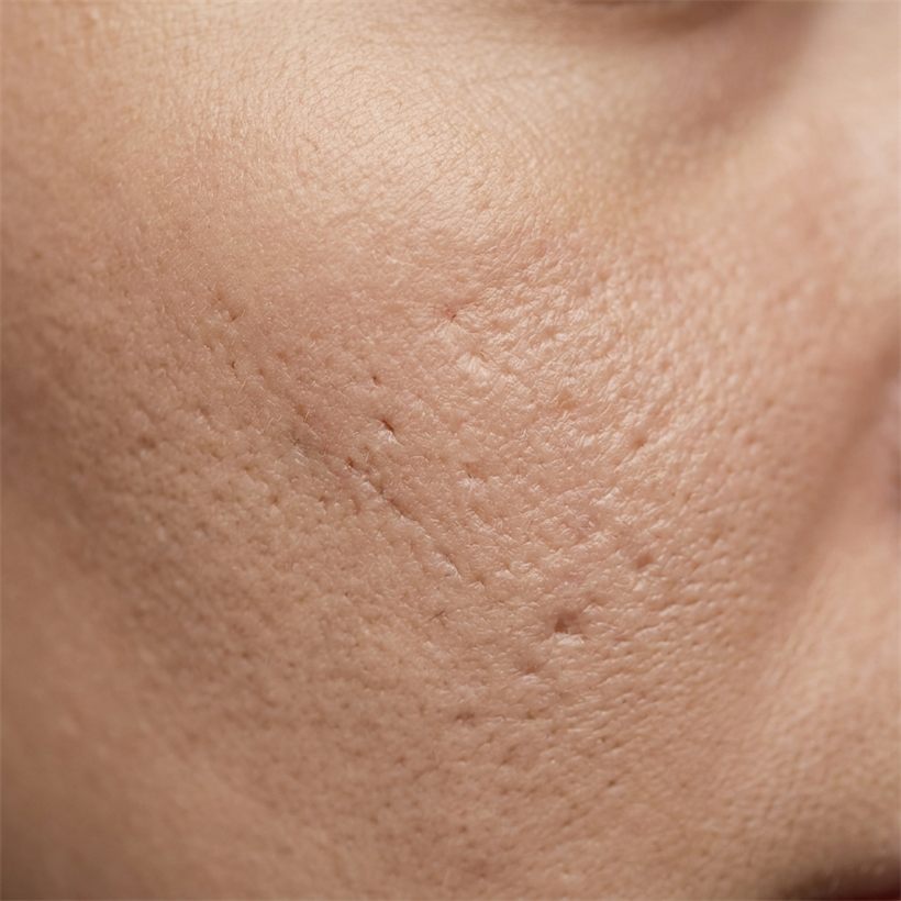 Skin texture affected by a fungal rash